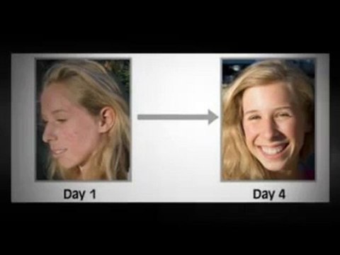 Acne Free In 3 Days,Step-by-Step To An Acne-Free Skin