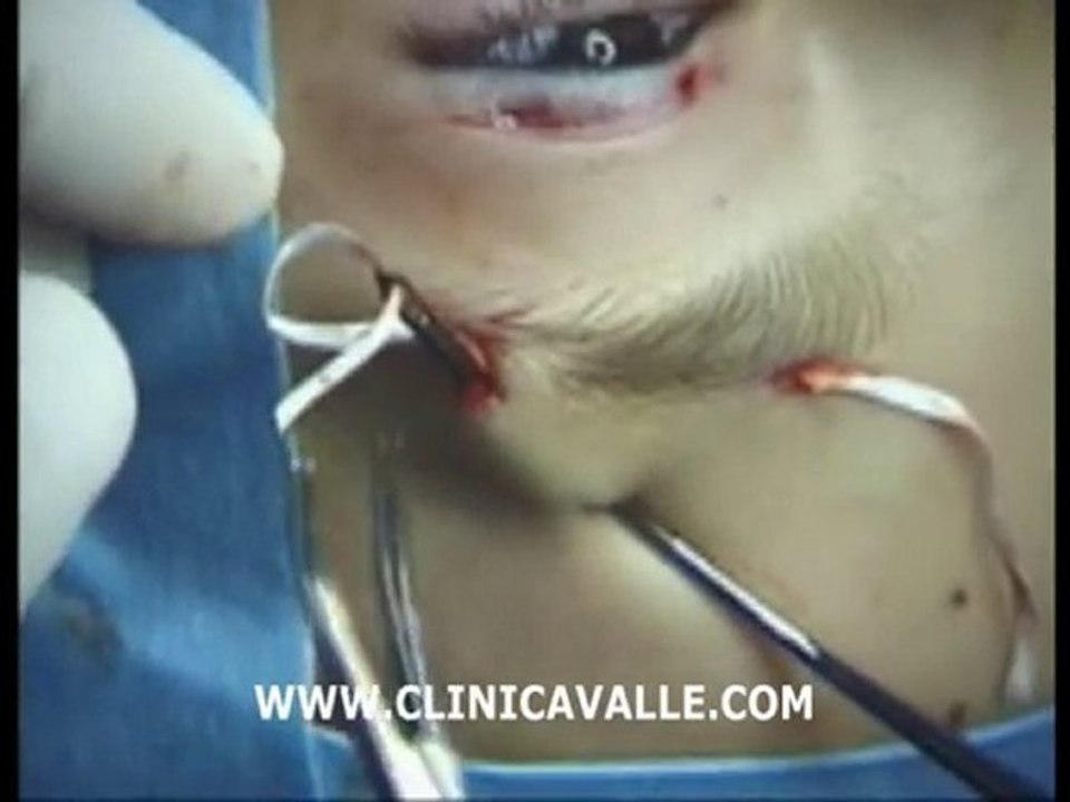 Ptosis Palpebral