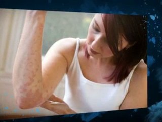 Eczema Cures Natural| Eczema Cure Natural| Eczema Treatment