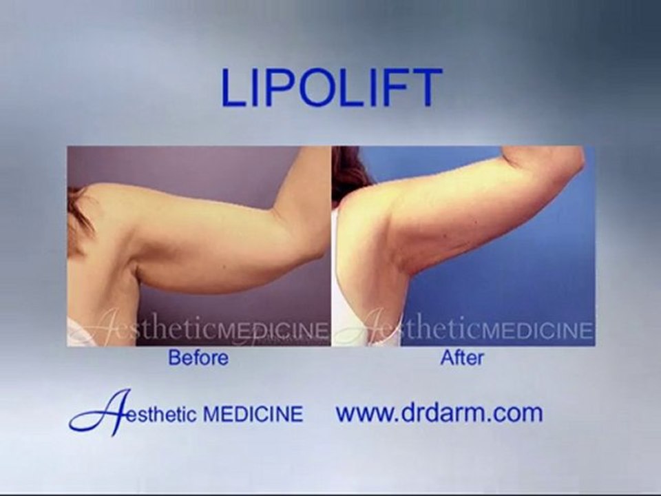 Before and After - Lipolift arms