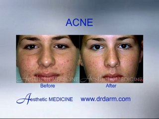 Before and After - Skin Problems Acne