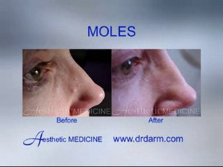 Before and After - Skin Problems Moles