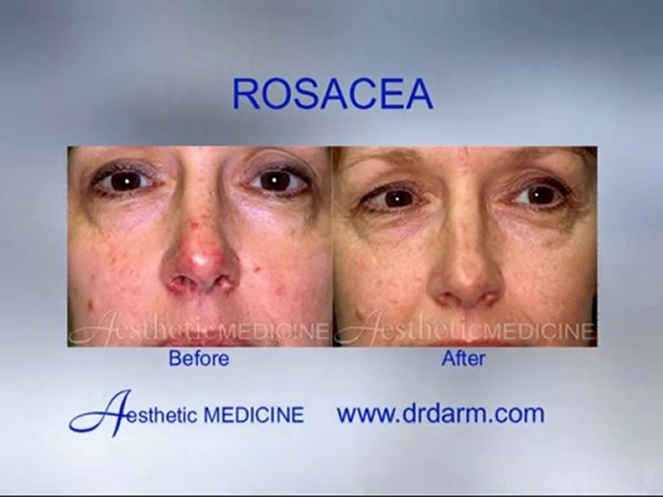 Before and After - Skin Problems Rosacea
