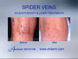 Before and After - Spider Veins Sclerotherapy & Lasers