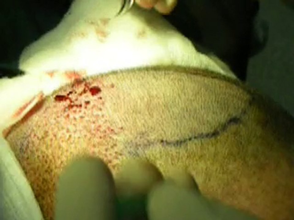 Follicle Unit Extraction(FUE) hair transplant  in Pakistan