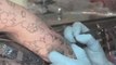 Tattoos And Your Health : What are the risks associated with getting a tattoo?