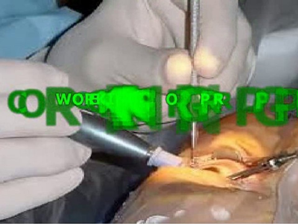 Lasik-surgery