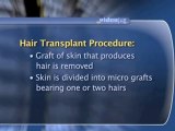 Hair Transplant : How is a hair transplant performed?
