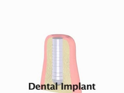 Oral Surgery, Dental Implants : What are dental implants ?
