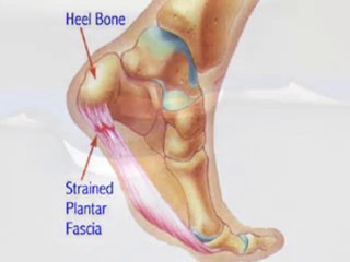 Heel Pain Diagnosis and Treatment - Podiatrist in Columbus,