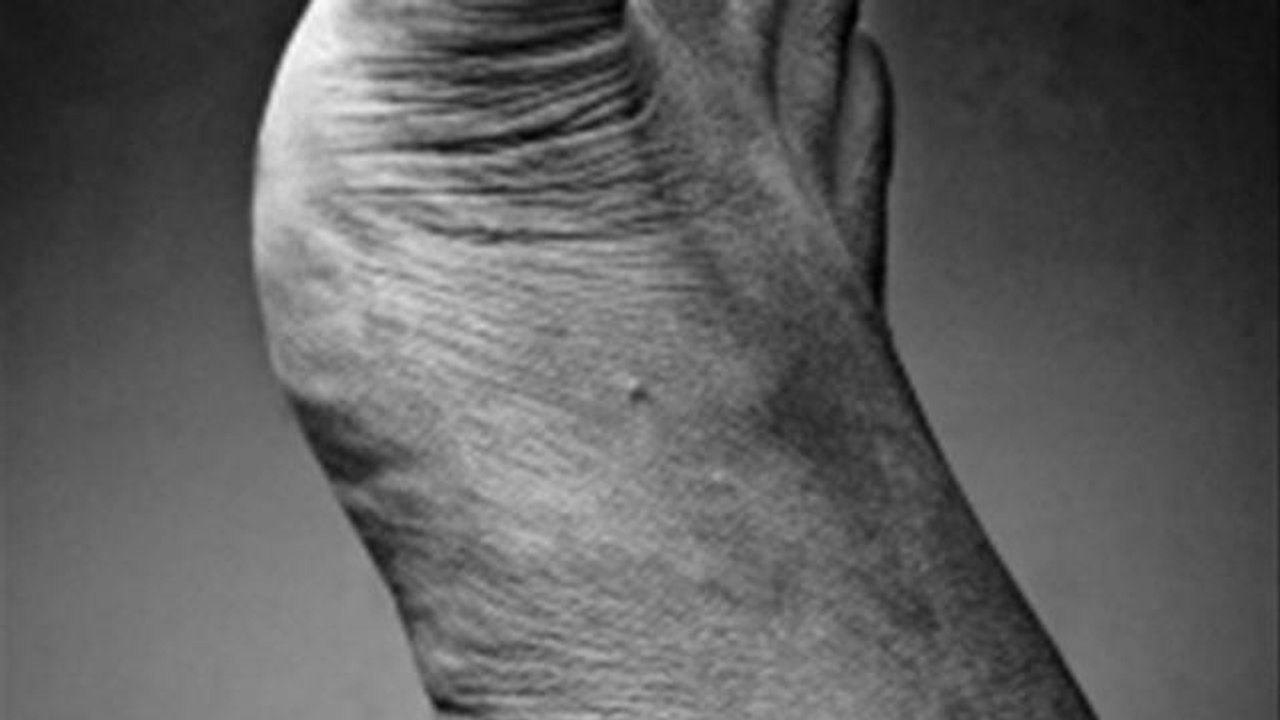 How To Manage Tinea Pedis