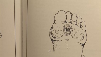 How To Get Rid of Corns