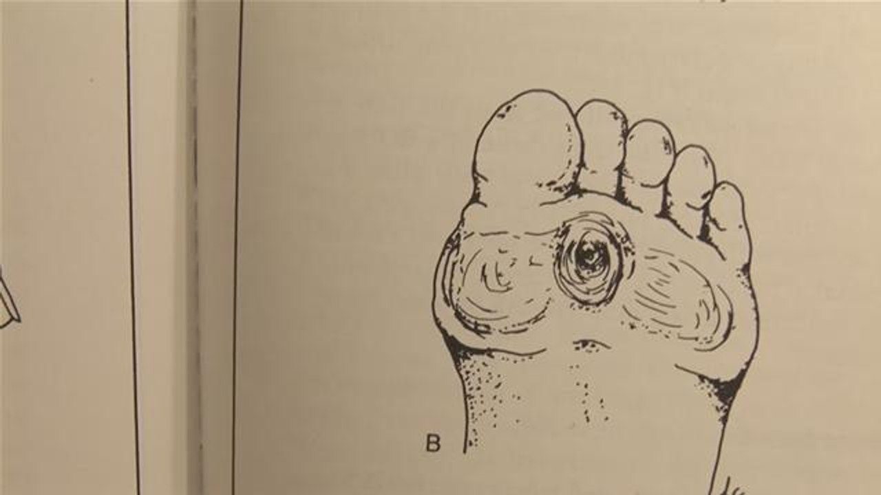 How To Get Rid of Corns