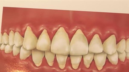 How To Treat Receding Gums