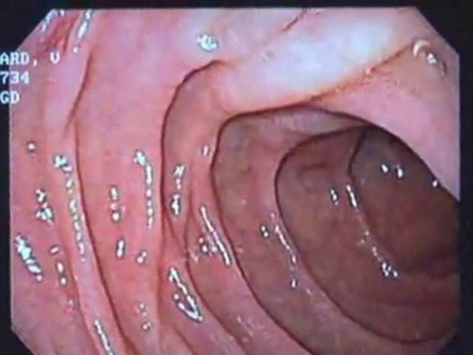 Celiac Disease : How is celiac disease diagnosed?