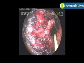 KALIN BAGIRSAK KANSERİ STENTLEME