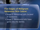 Skin Cancer Basics : What are the stages of melanoma skin cancer?