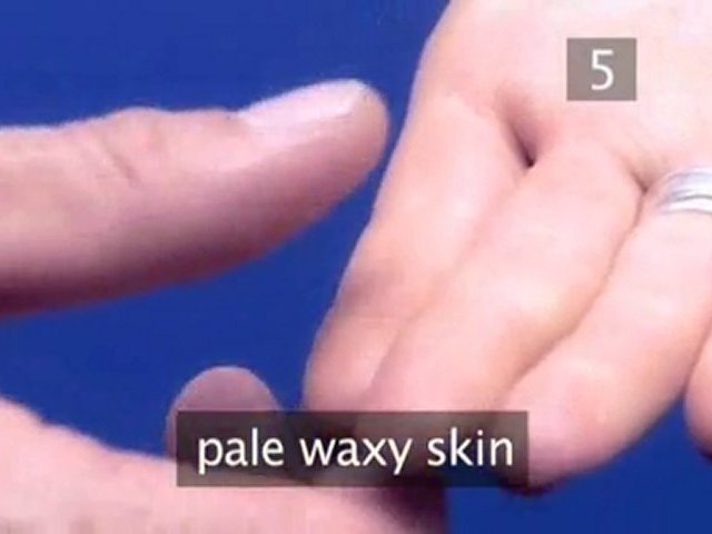 How To Check Circulation After Bandaging