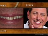 Cosmetic Dentistry Institute - Troy & Detroit–Veneer Patient