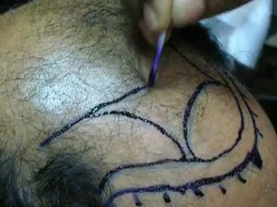 Frontal hairline Marking - hair transplant clinic Pakistan