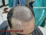 Hair Transplant in Pakistan,Best Hair Transplant in Pakistan