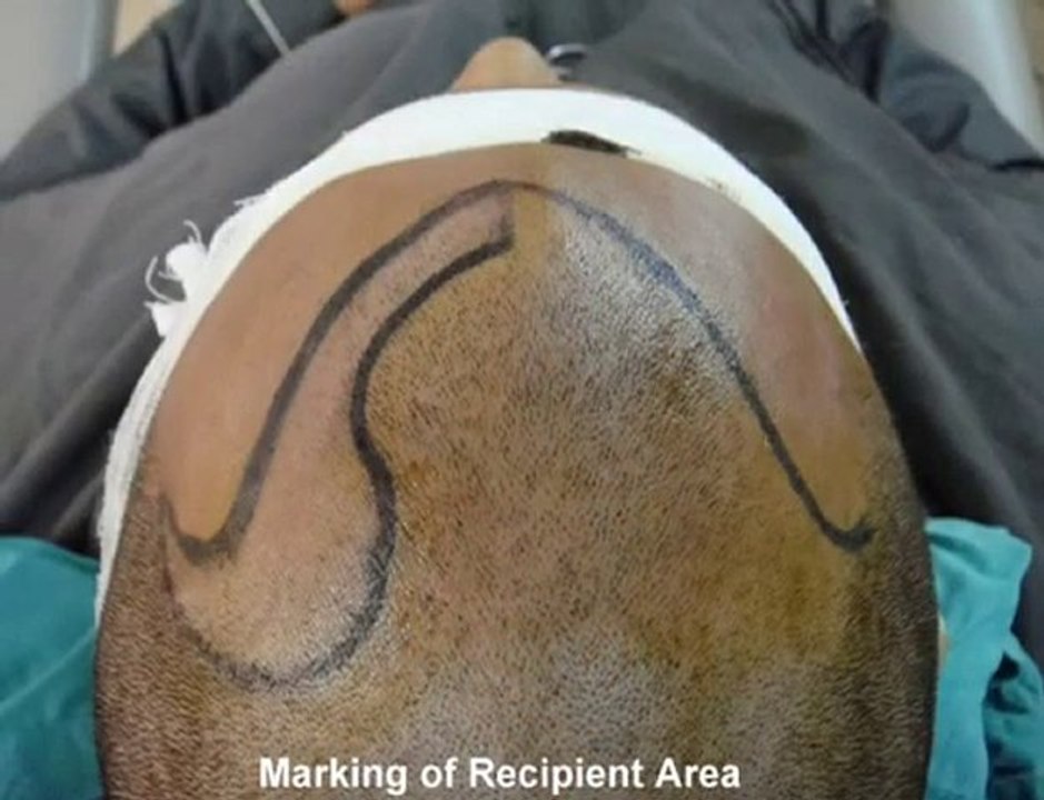 FUE in Pakistan,FUE in Lahore,Hair Transplant Pakistan