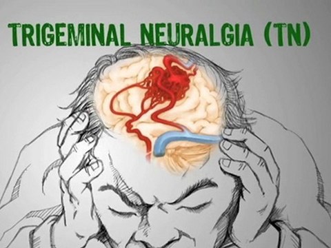 Living With Trigeminal Neuralgia? Trigeminal Neuralgia ...