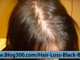 Hair Loss Regrowth - Stop Hair Loss Now - Hair Loss Men