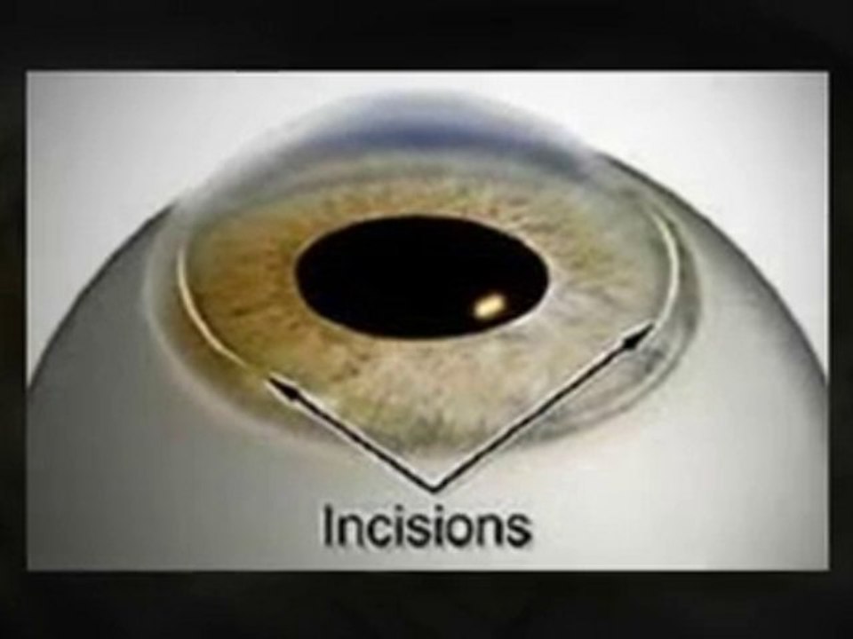 Why Choose an Austin Eye Surgery