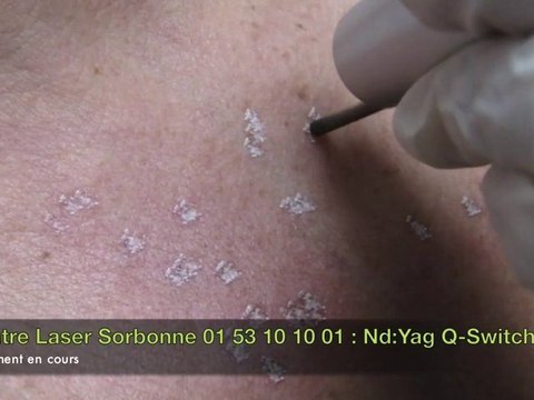 Vidéo traitement laser des Taches brunes