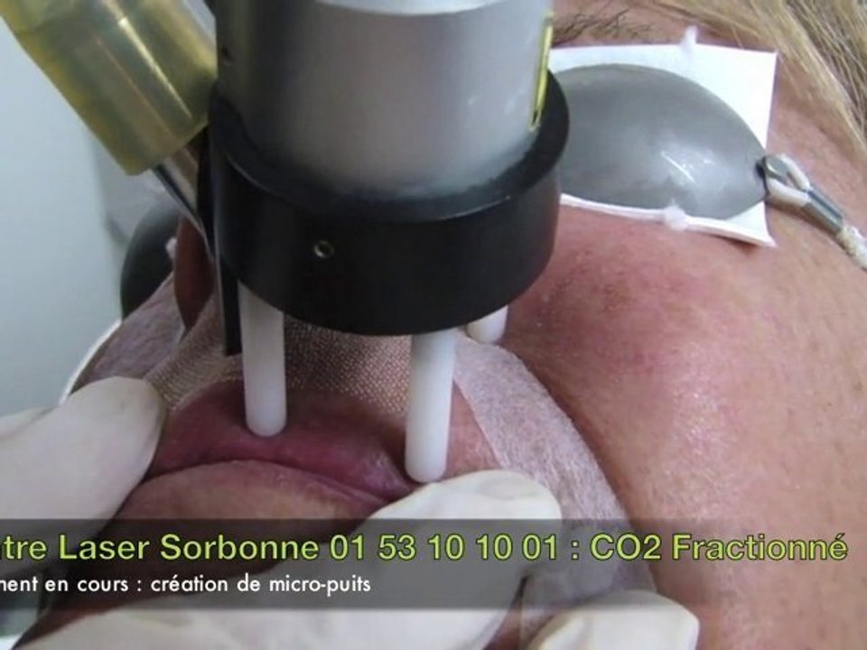 Vidéo traitement laser des Rides péri-buccales