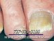Ingrown Toenails and Fungal Nails - Podiatrist in Clearwater