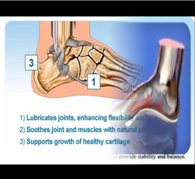 Mortons Neuroma - You don't need surgery!