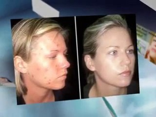 Acne Treatment Using Adapalene