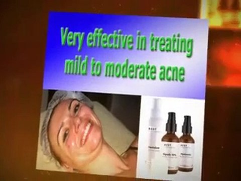 Glycolic Peels For Acne Treatment
