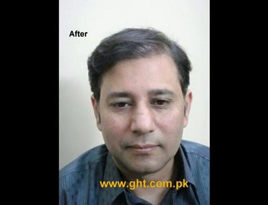 Hair Transplant in Pakistan