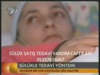 sülük TEDavİ sülük SATIŞ manisa göz