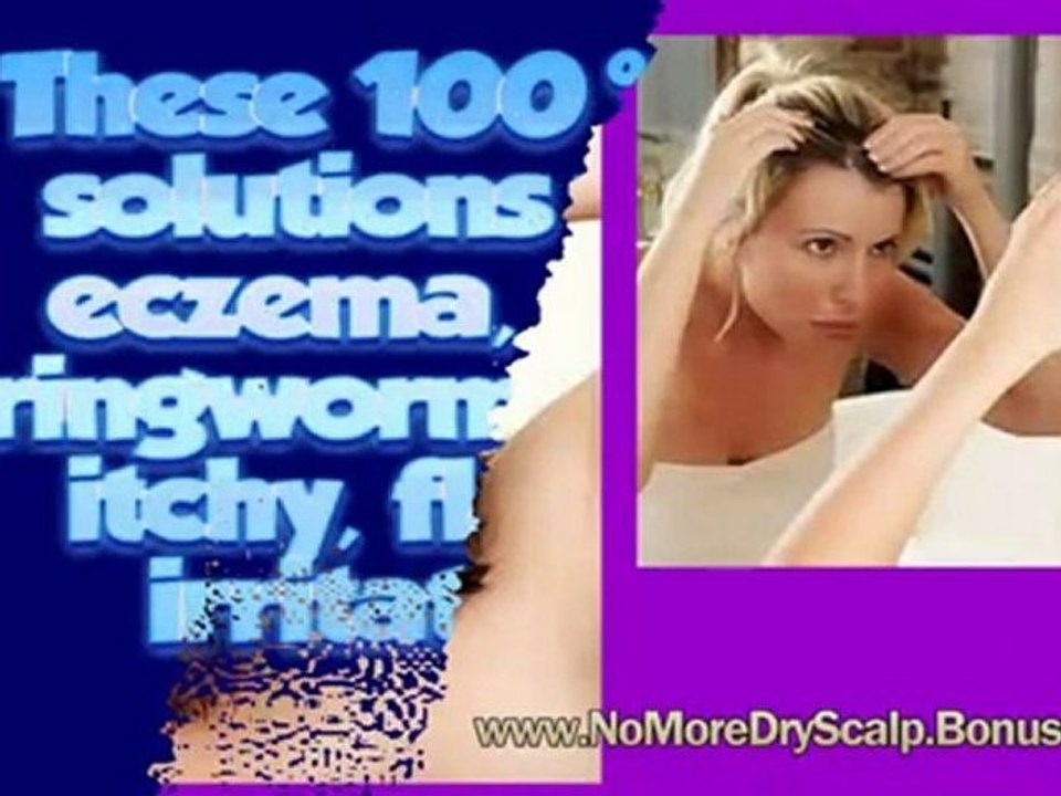 dandruff home remedy - dandruff remedies - get rid of dandru