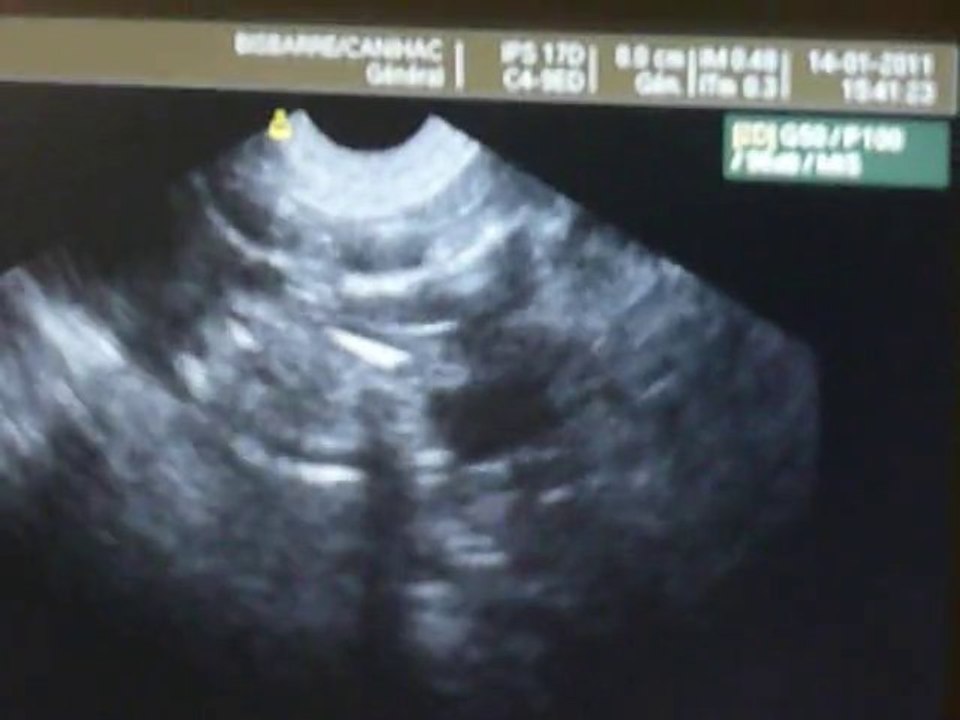 Echographie Daisy 3 semaines 1/2 fin