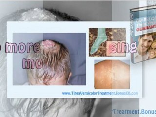 tinea versicolor yeasts tinea versicolor rash diet ebook