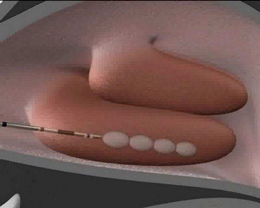 Nasenmuschel Behandlung