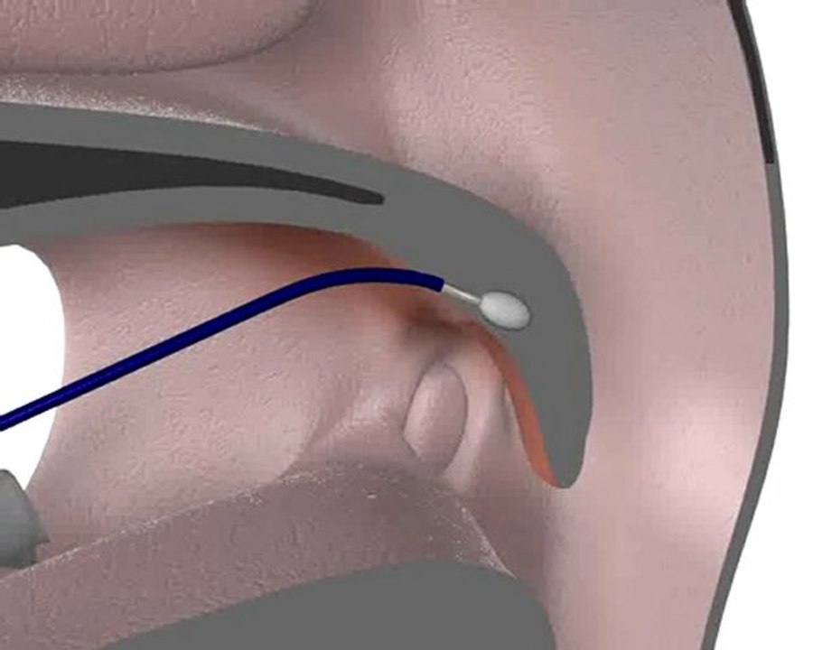 Weichgaumen Koagulation