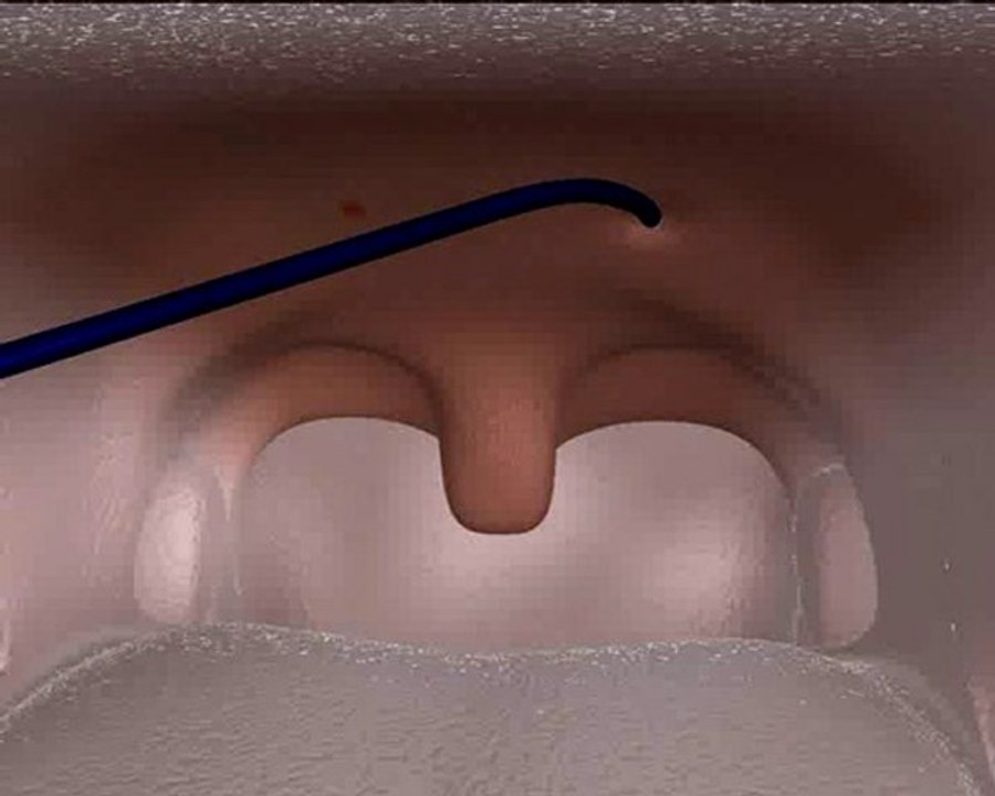 Weichgaumen Punktionen Yildiz-Protokoll