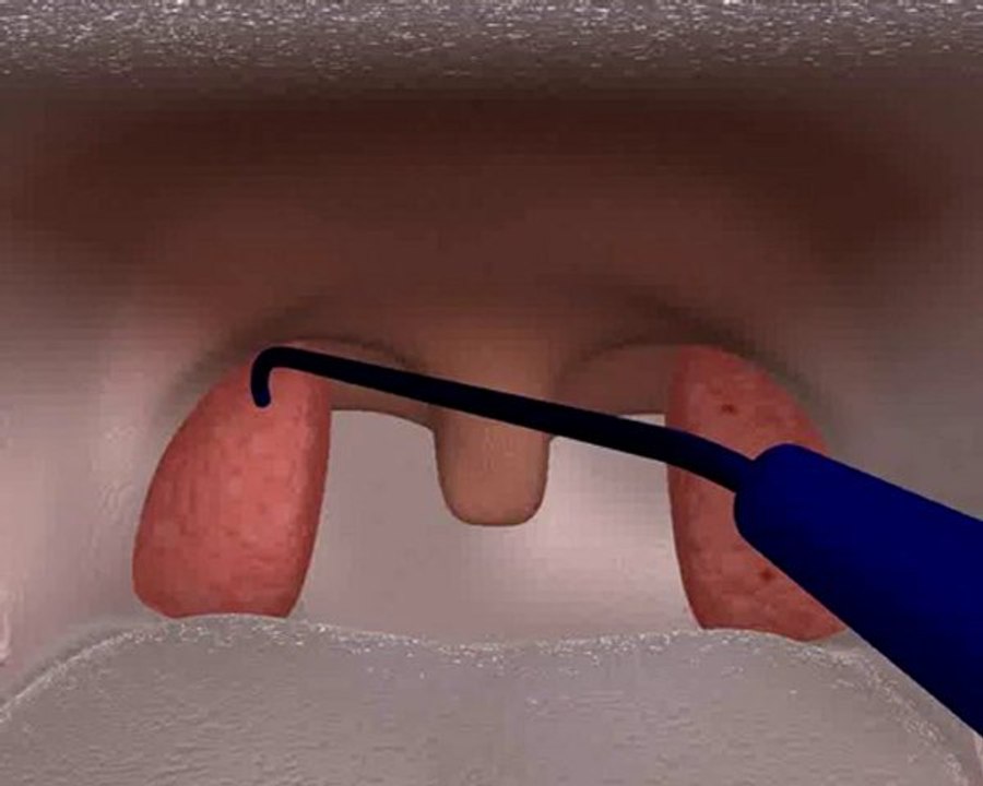 Tonsillen Behandlung