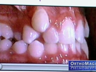 Temporary Anchorage Devices – Orthodontics in Detroit, MI