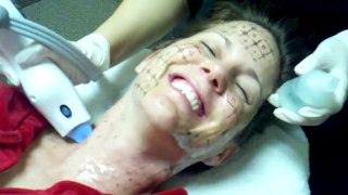 Biz Haddock Gets Fraxel Restore On Her Face