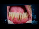 Cosmetic Dentist Harrisonburg VA|Dental Implants|Dental Bri