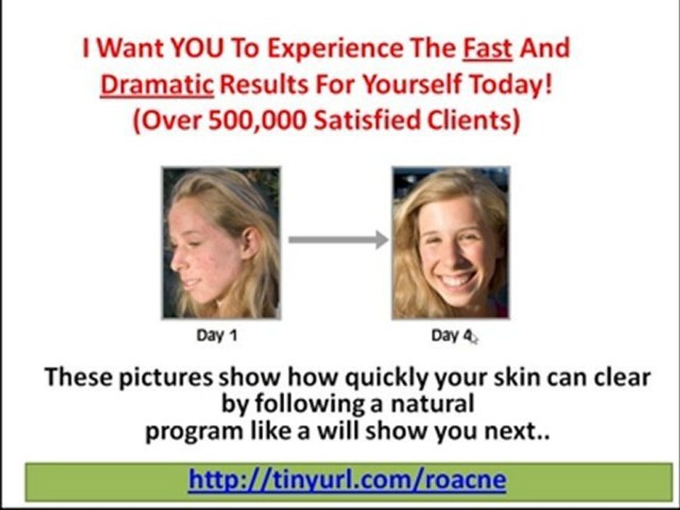 How to Get Rid of Zits - Best Acne Treatment!