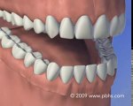 Prothèse complète mandibulaire