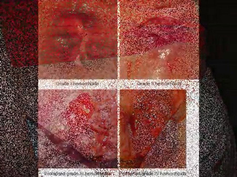 Hemorrhoid Cure in 24 hours!